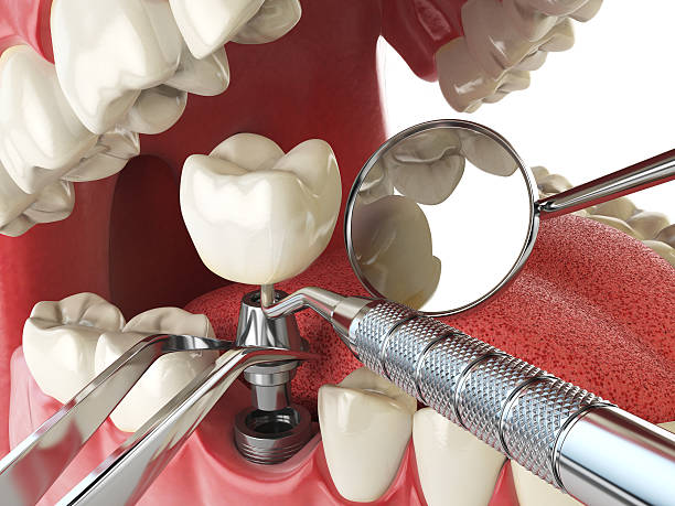 Best Emergency Dentist for Lost Fillings or Crowns in Sarand, AL